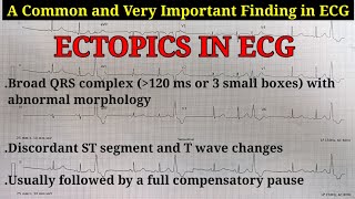 ECG Ectopics Explained  Learn about Ectopics APCs amp VPCs  Ventricular Trigeminy ECG [upl. by Yorel]