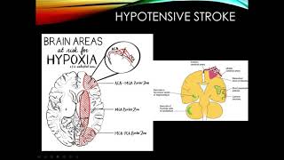 Cerebrovascular Disease Part 2 [upl. by Ahouh]