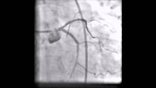 Left main coronary angioplasty due to dissection [upl. by Ardnasirhc]