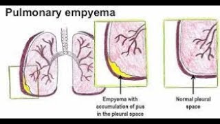 Pleural Empyema  empyema  causes symptoms treatment  empyema medicine lecture  empyema [upl. by Nelon]