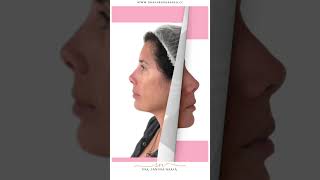 ✨ Perfiloplastia sin cirugía✨ bellezaintegral armonizaciónfacial [upl. by Richers]