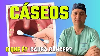 👄 Cáseos Amigdaliano Pode Causar Câncer Descubra o que São caseum [upl. by Rosenkranz630]