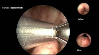 Urolift 2 implant case [upl. by Eclud]