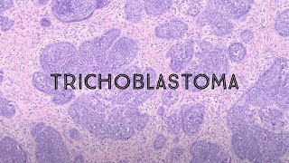 Trichoblastoma mimic of basal cell carcinoma skin adnexal tumor hair follicle tumor pathology [upl. by Enileme]