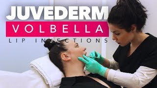 Juvederm Volbella Lip Injections  Juvederm Volbella Los Angeles CA [upl. by Folly926]