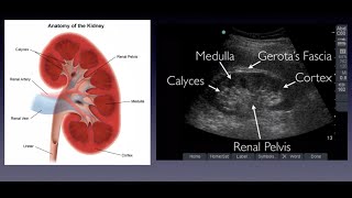 Introduction to Renal Ultrasound [upl. by Mackintosh]