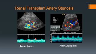 Renal Transplants [upl. by Colis]