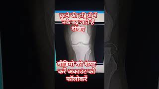 knee joint X Ray osteophytic changes youtuber youtubeshort youtubevideo youtubviralvideo [upl. by Sikes174]