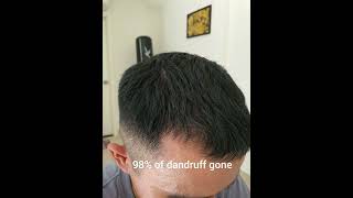 Day 30 Of Minoxidil Treatment  Without Finasteride [upl. by Notelrac237]