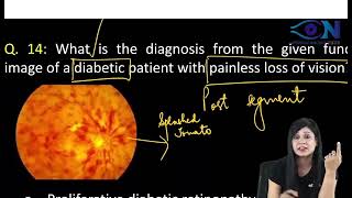 Ophthalmology PYQsFMGE28  Dr Niha Aggarwal [upl. by Parrisch]