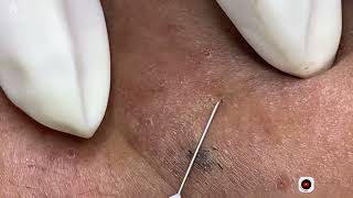 Big Cystic Acne Blackheads Extraction Blackheads amp Milia Whiteheads Removal Pimple Popping [upl. by Eanej]