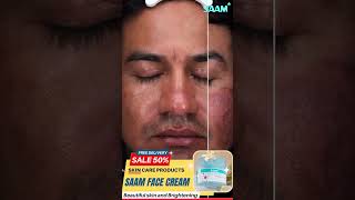 Do you know this melasma solution Remove melasma from 2 weeks melasmacream melasmatreatment [upl. by Stormi]