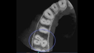 CS 81003D Endodontic 5 Canal Case [upl. by Lenes172]