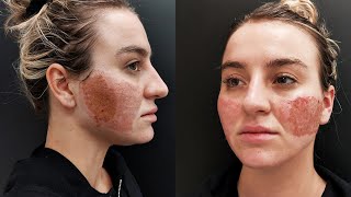 Acne Scar Removal with CO2 Laser Treatment  Before amp After [upl. by Enyrehtak]