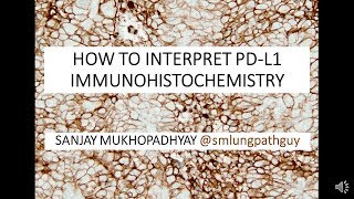 How to interpret a PDL1 immunostain [upl. by Locke]