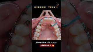 Braces change your smile braces orthodontist dentistteeth shorts [upl. by Aldis]