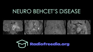 Neuro Behcets Disease Imaging Walkthrough  Radiofreediaorg [upl. by Colon387]