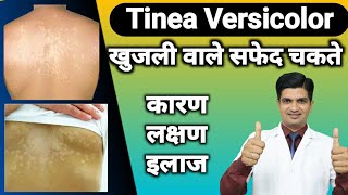 Skin की बीमारी  Tinea versicolor cause treatment [upl. by Yelnek]