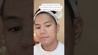 Just trust the process 😍😍 acnejourney skincare acne [upl. by Philana]