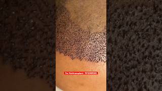 Oily scalp problem after hair transplant  Vaarun Tiwari hairtransplant [upl. by Nyrraf]