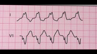 Tachycardie ventriculaireMorphologie du bloc de branche gauche [upl. by Messing943]
