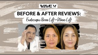 Before and After Endoscopic Brow lift with a Mini Facelift Wavelift  Wave Plastic Surgery [upl. by Airebma]