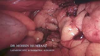 Sleeve Gastrectomy  Performed By Dr Mohsin Mumtaaz  Bariatric Surgery [upl. by Nipahc]