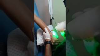 Eliminacion de Tatuajes con laser en Guadalajara [upl. by Kendyl]