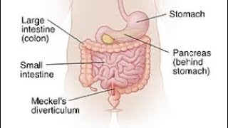 Mcqs on Meckel’s diverticulum surgerysurgeryeducationneetpg [upl. by Vanni]