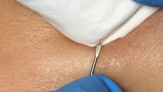 Ingrown Hairs Extraction  16 minutes [upl. by Handal]