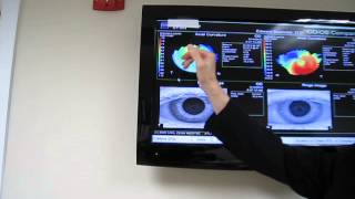 AN EXPLANATION OF CORNEAL TOPOGRAPHY AND KERATOCONUS [upl. by Mosenthal]