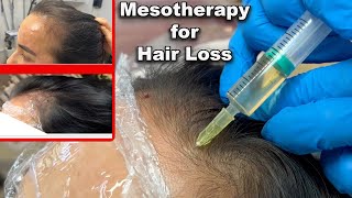 Mesotherapy for hair loss amazing results Before and after photos post 4th session [upl. by Angeli]