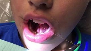 Functional frenuloplasty updated technique with lingual palatal suction [upl. by Findley]