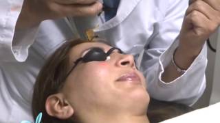 Tratamiento de la Rosacea con Laser DR LUIS EDUARDO MARTINEZ CLINILASER [upl. by Inah594]