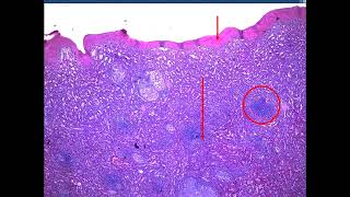 Sarcoidosis Rhino Actinomycosis Leprosy FB 2024  jars and slides [upl. by Imekawulo]