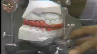 Occlusal Adjustment  Centric Relation [upl. by Eselehs]