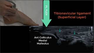 Deltoid Ligament Ultrasound 2023 [upl. by Holladay425]