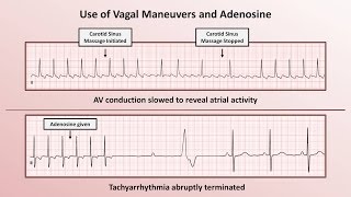 Intro to EKG Interpretation  How to Identify Any Tachyarrhythmia with 6 Easy Questions [upl. by Quinn]