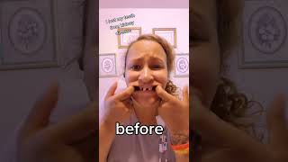 😁 I lost my teeth from Kidney Disease 😁 Instant Smile Teeth Veneers 2023 [upl. by Tabor]