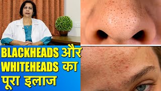 कील और सफ़ेद दानों का पूरा इलाज  Complete and Safe Treatment for Blackheads amp Whiteheads [upl. by Egwan]