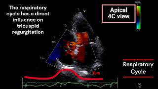 Tricuspid Regurgitation and Respiratory Cycle [upl. by Aikcir71]