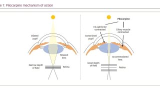 Using Muscarinic Agonist drugs Pilocarpine to treat Glaucoma [upl. by Maisie551]