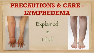 Precautions amp care in Lymphedema explained in Hindi [upl. by Wallace962]