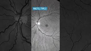 Macular telangiectasia type 2 👵🏻 🏆 📸 Clarus 700 from Zeiss retina oftalmo ophthalmology ofta [upl. by Astrid]