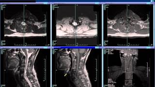 MRI of Quadriplegic c57 [upl. by Leonsis]