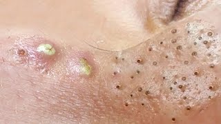 Big Cystic Acne Blackheads Extraction Blackheads amp Milia Whiteheads Removal Pimple Popping  1174 [upl. by Llerrit]