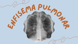 ENFISEMA PULMONAR EN RADIOLOGÍA TELE DE TÓRAX SIGNOS RADIOLÓGICOS [upl. by Yeleak865]