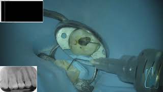 LIVE ENDODONTIC TREATMENT  first upper molar 40 minutes 4 canals [upl. by Oliva]