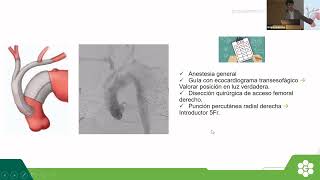 Aorta Endovascular Rosario 2022  Disección aórtica tipo B crónica ¿Cuándo y cómo intervenir [upl. by Winston312]