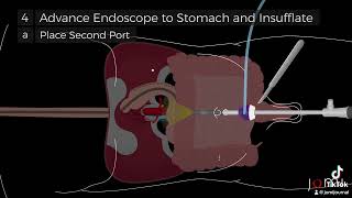 LaparoscopicAssisted Percutaneous Endoscopic Gastrostomy PEG Tube Placement Steps [upl. by Sharleen723]